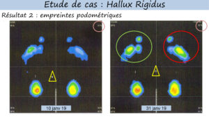 appuis et meilleur equilibre hallux rigidus grâce reflexologie globale canadienne lyon