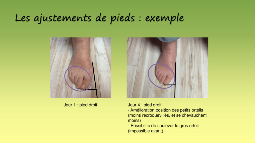 correction hallux valgus formation reflexologie globale lyon